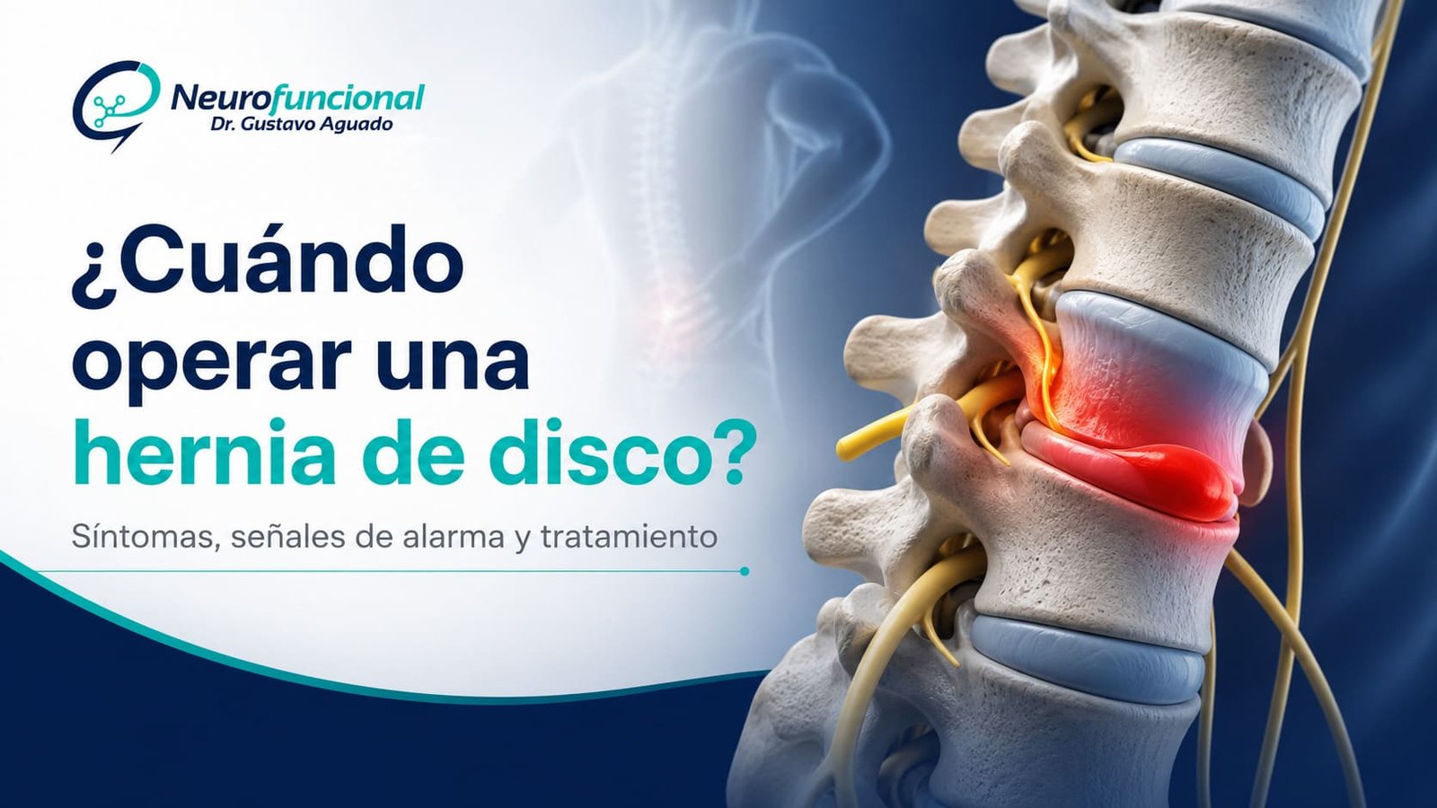 Hernia de disco lumbar con compresión nerviosa y dolor
