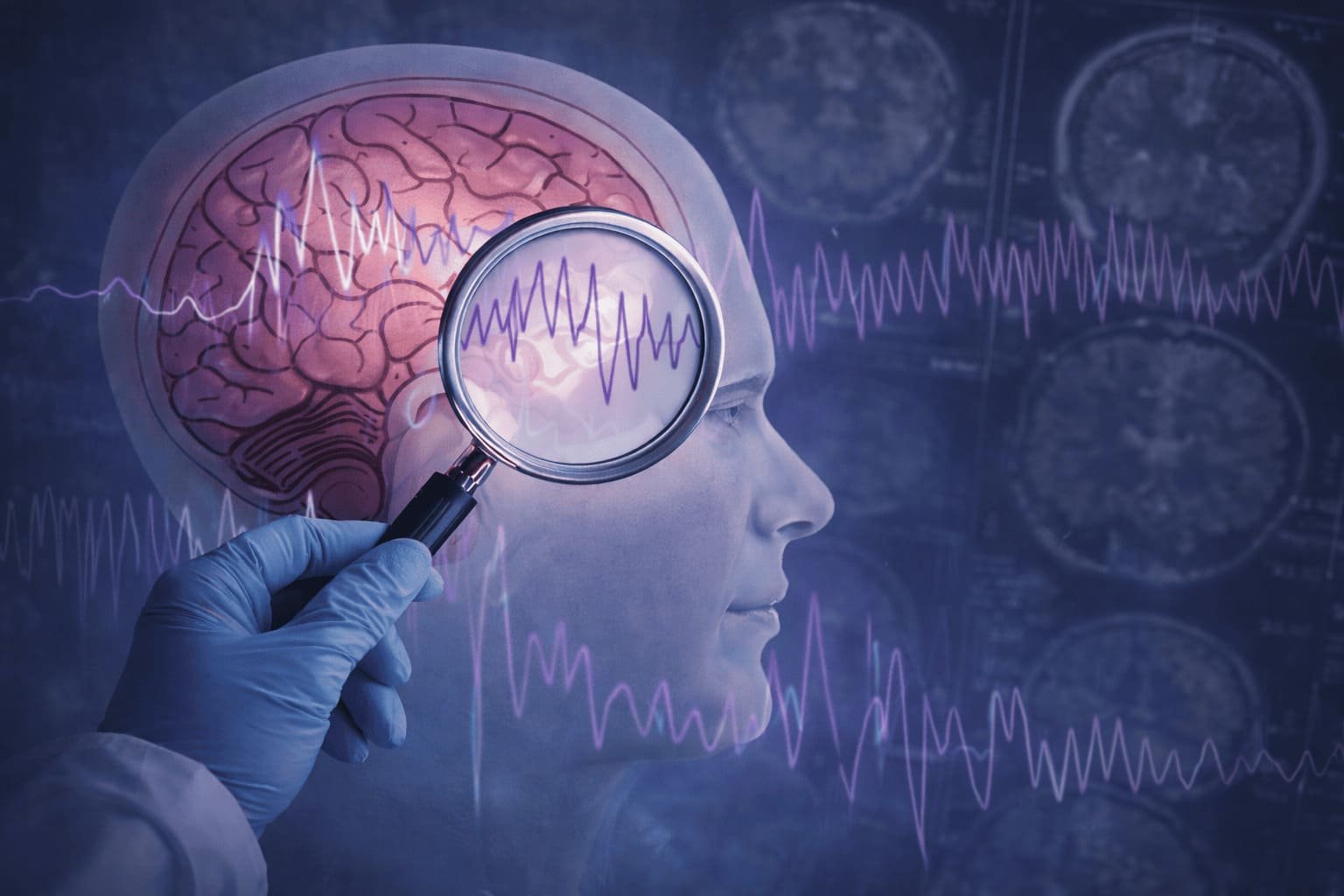 Epilepsia como enfermedad neurológica del cerebro